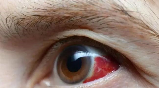 Eye Infection Spreads in City, Madras Eye Triggers Health Scare